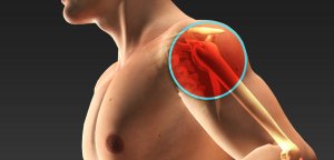 Диагностика и оценка ограничения внутренней ротации в плечевом суставе